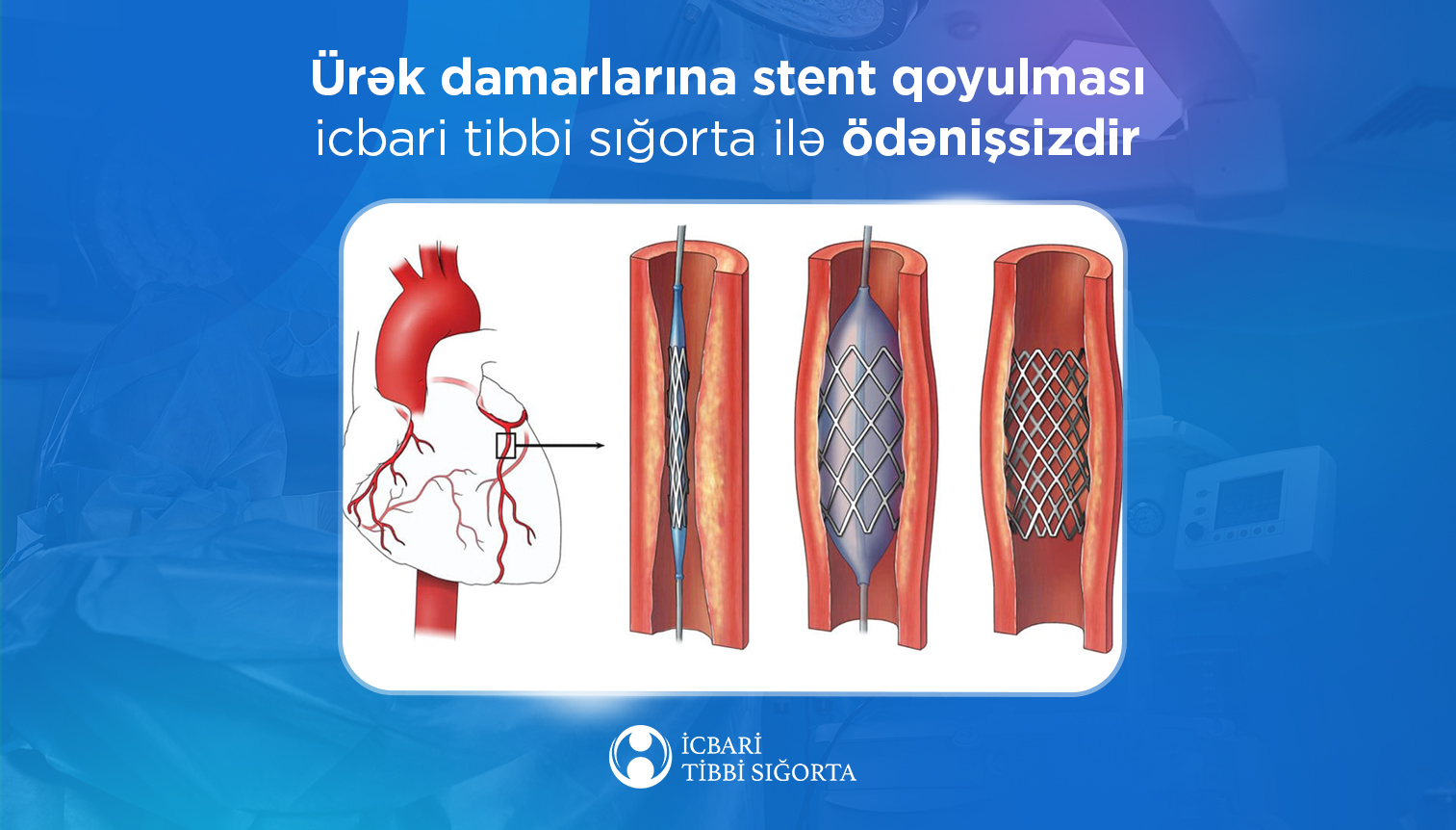 Ürək damarlarına stent qoyulması icbari tibbi sığorta ilə ödənişsizdir